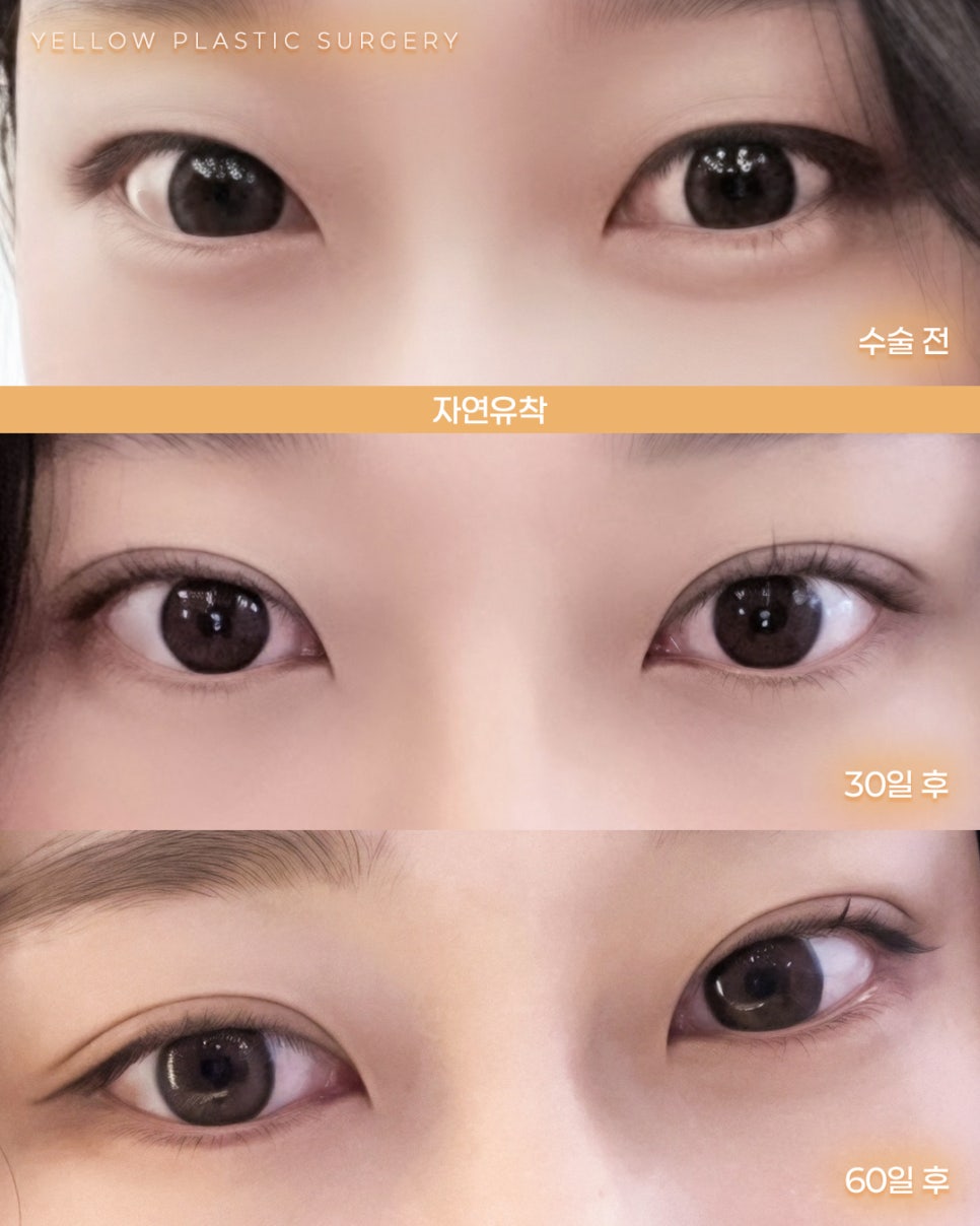 [ 강남역 옐로우성형외과 / 눈성형 ] 자연유착 관련 이미지 1