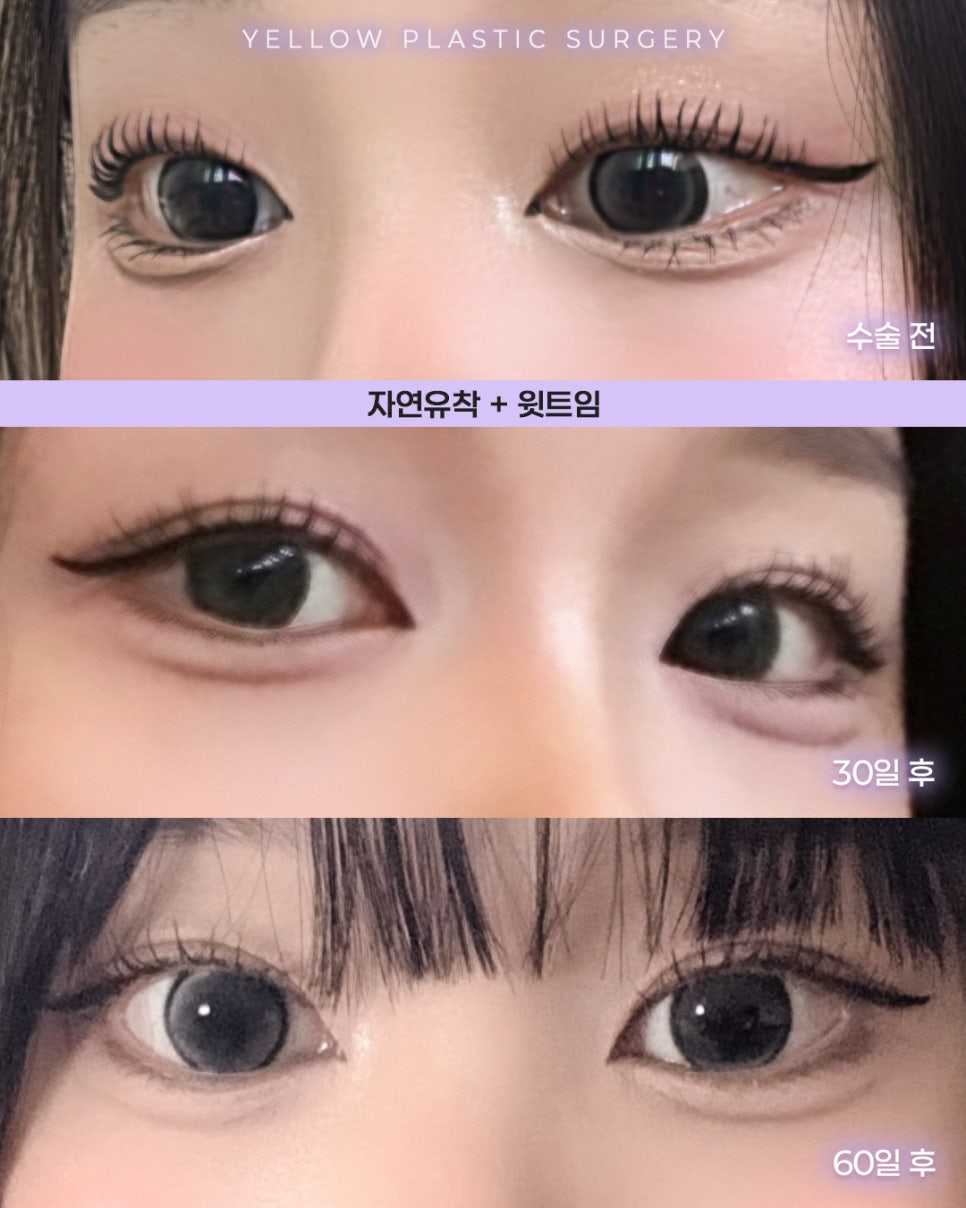 [ 강남역 옐로우성형외과 / 눈성형 ] 자연유착 + 윗트임 관련 이미지 1