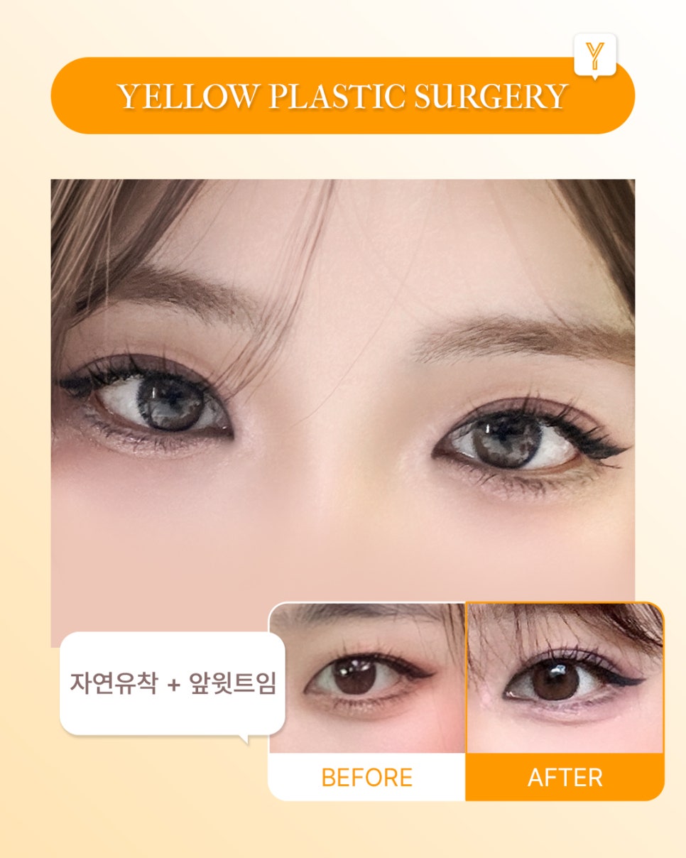 [ Gangnam Station Yellow Plastic Surgery / Eye Surgery ] Natural Adhesion + Front Upper Epicanthoplasty image 1
