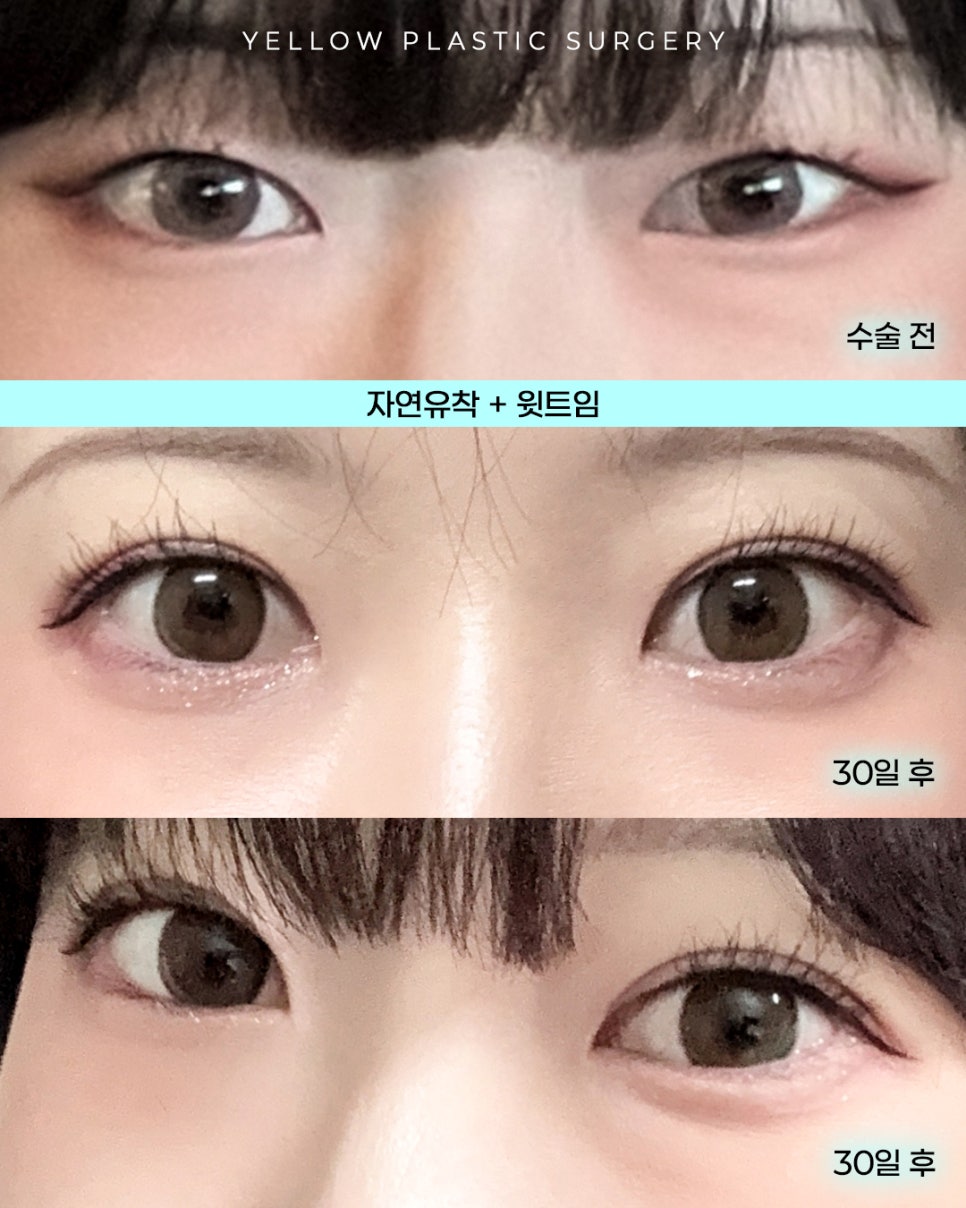[ Gangnam Station Yellow Plastic Surgery / Eye Surgery ] Natural Adhesion + Upper Epicanthoplasty image 1