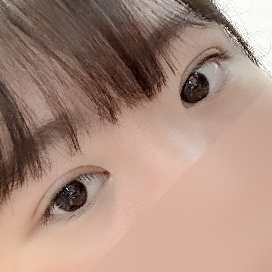 [ 강남역 옐로우성형외과 / 눈성형 ]  부분절개 앞트임 윗트임 수술 후기 2개월차 4개월차 관련 이미지 5