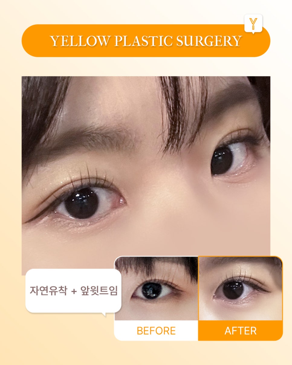 [ Gangnam Station Yellow Plastic Surgery / Eye Surgery ] Non-incisional Double Eyelid Suture + Medial Upper Epicanthoplasty image 1