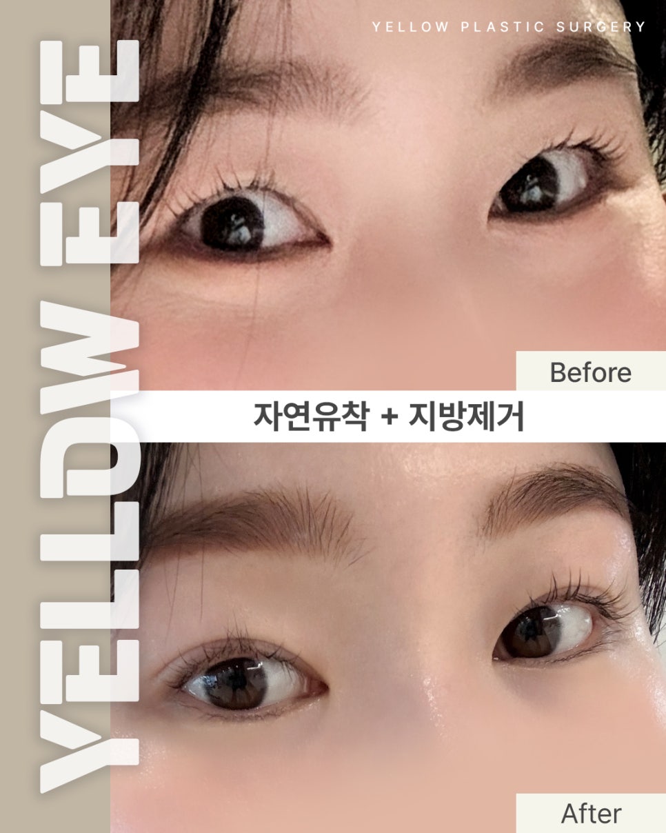 [ Gangnam Station Yellow Plastic Surgery Clinic / Eye Surgery ] Natural Adhesion + Fat Removal image 1