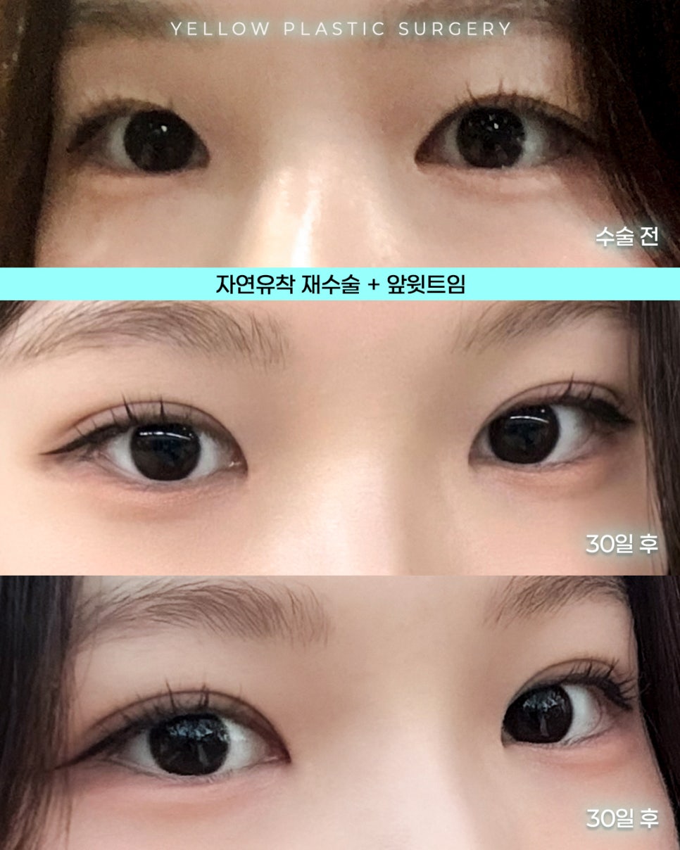 [ 강남역 옐로우성형외과 / 눈성형 ] 자연유착 재수술 + 앞윗트임 관련 이미지 1