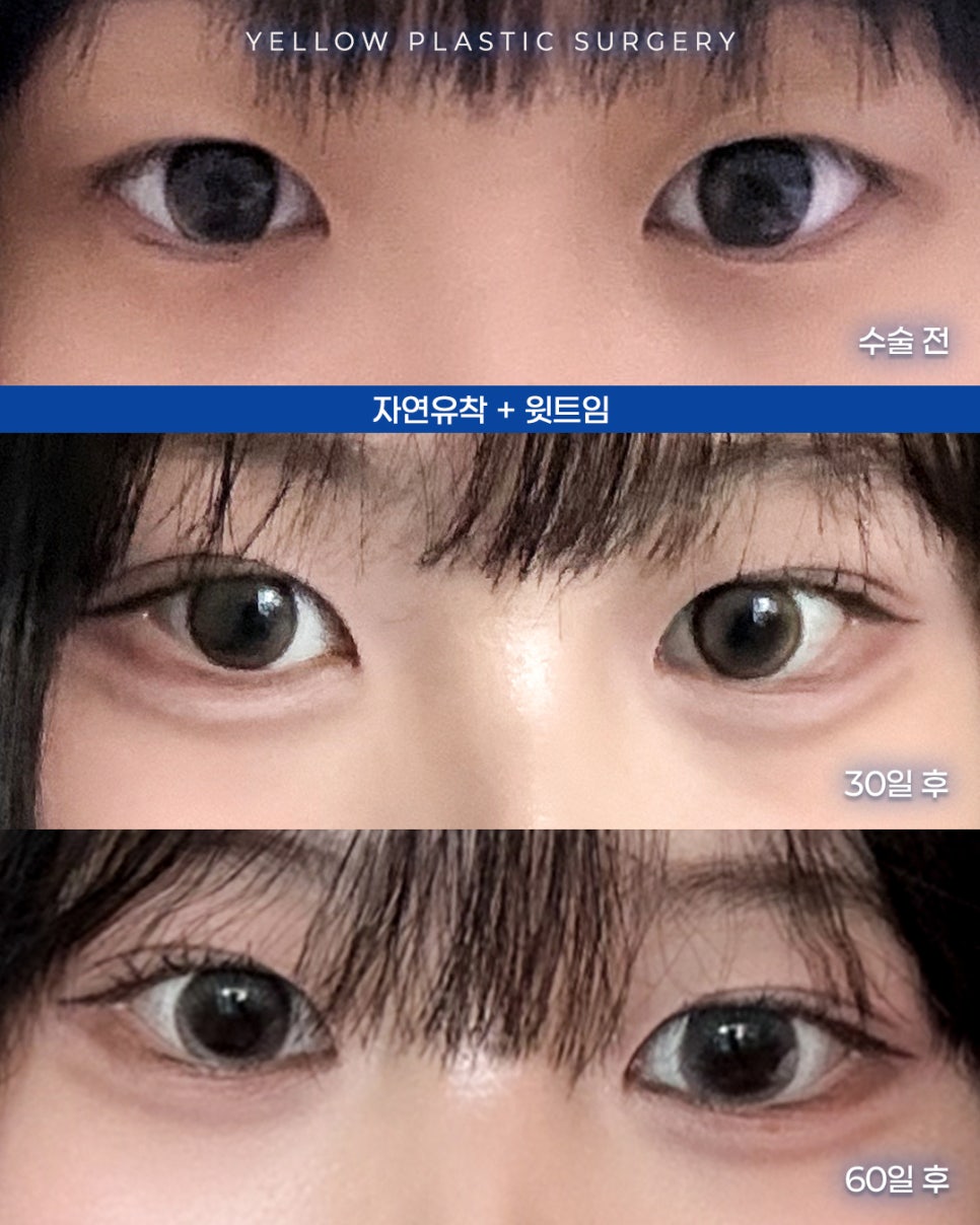 [ Gangnam Station Yellow Plastic Surgery / Eye Surgery ] Natural Adhesion + Upper Canthoplasty image 1