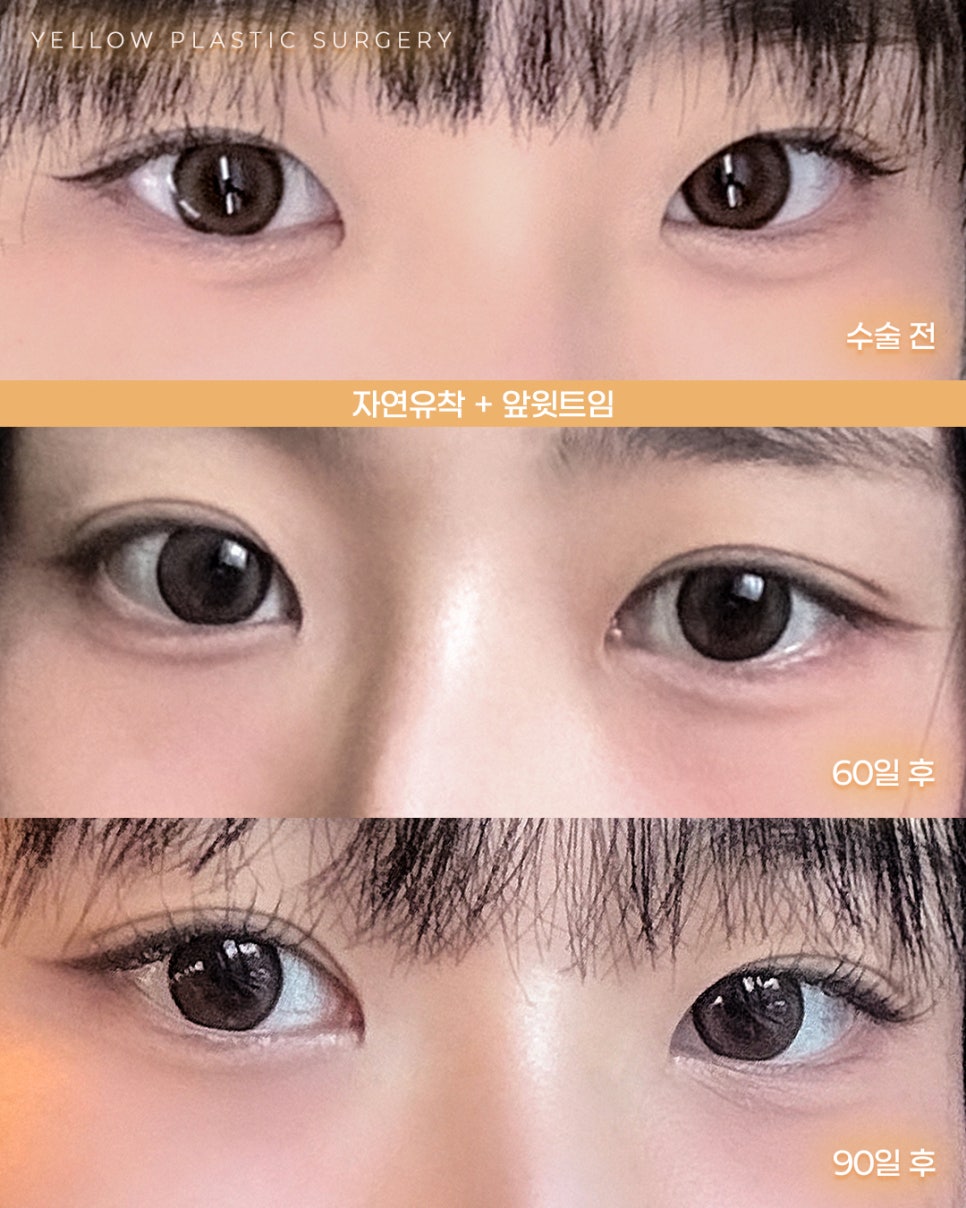 [ 강남역 옐로우성형외과 / 눈성형 ] 자연유착 + 앞윗트임 관련 이미지 1