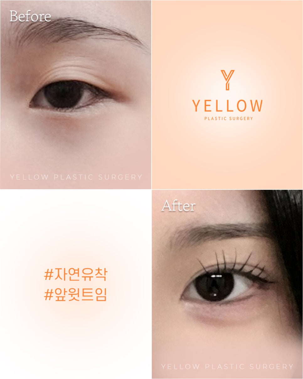 [Gangnam Station Yellow Plastic Surgery / Eye Surgery] Natural Adhesion + Front Upper Eye Corner Opening image 1