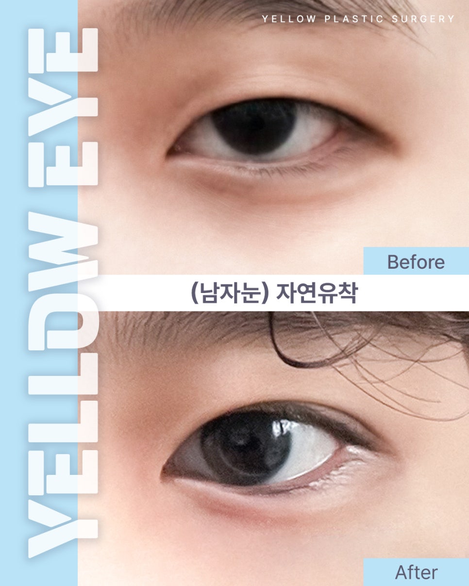 [ 강남역 옐로우성형외과 / 눈성형 ] (남자눈) 자연유착 관련 이미지 1
