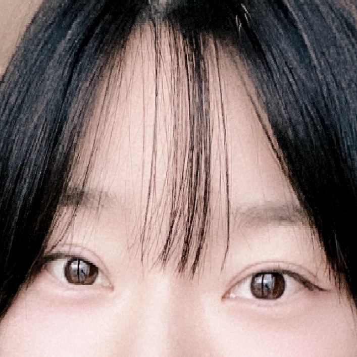[Gangnam Station Yellow Plastic Surgery / Eye Surgery] Seven-Month Review After First Partial Incision Surgery: Improvement in Uneven Eyes image 13