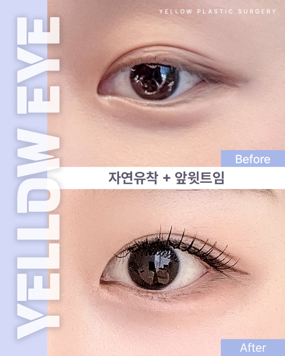 [ Gangnam Station Yellow Plastic Surgery / Eye Surgery ] Natural Adhesion + Inner Upper Eyelid Incision image 1