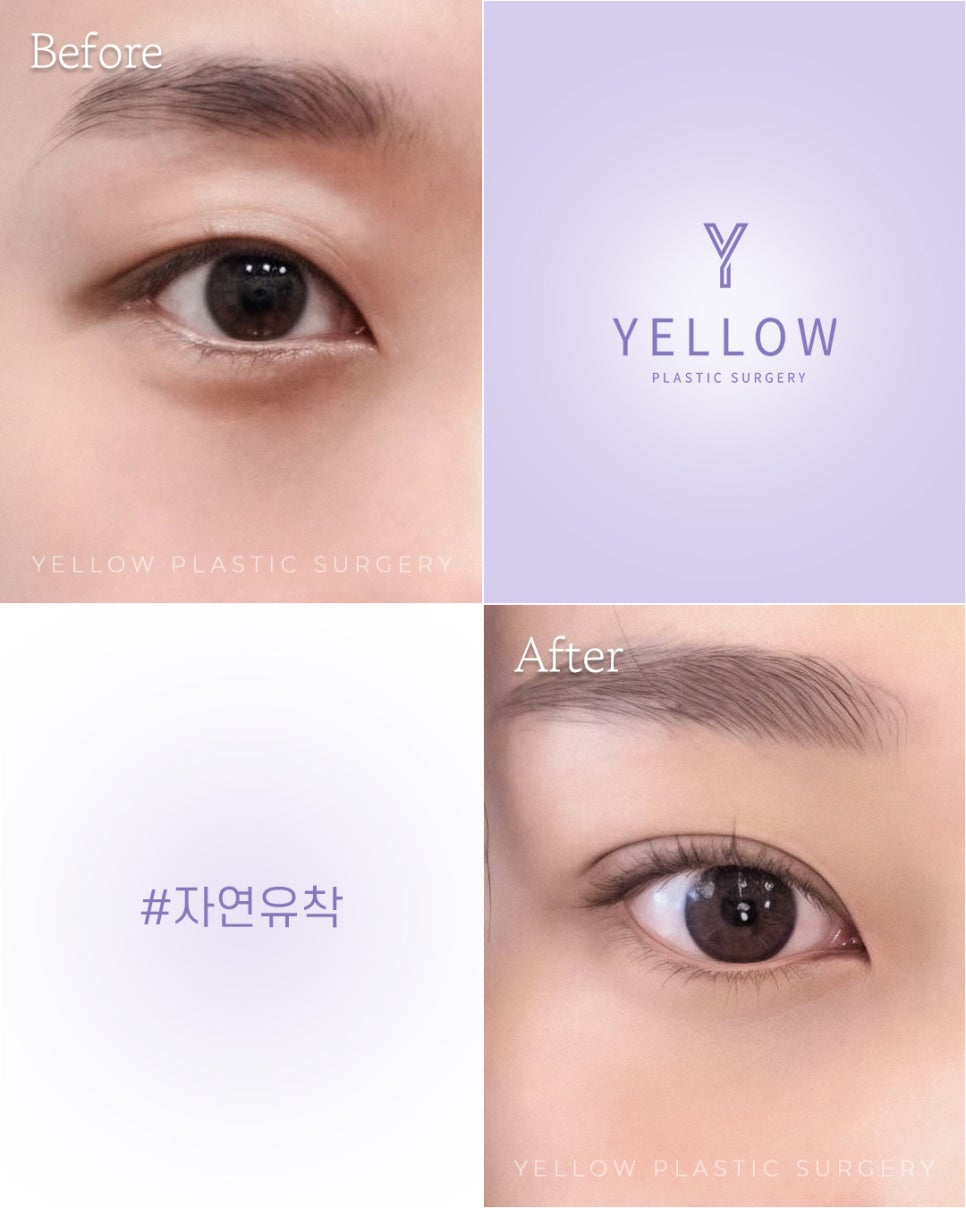 [ Gangnam Station Yellow Plastic Surgery / Eye Surgery ] Natural Adhesion image 1