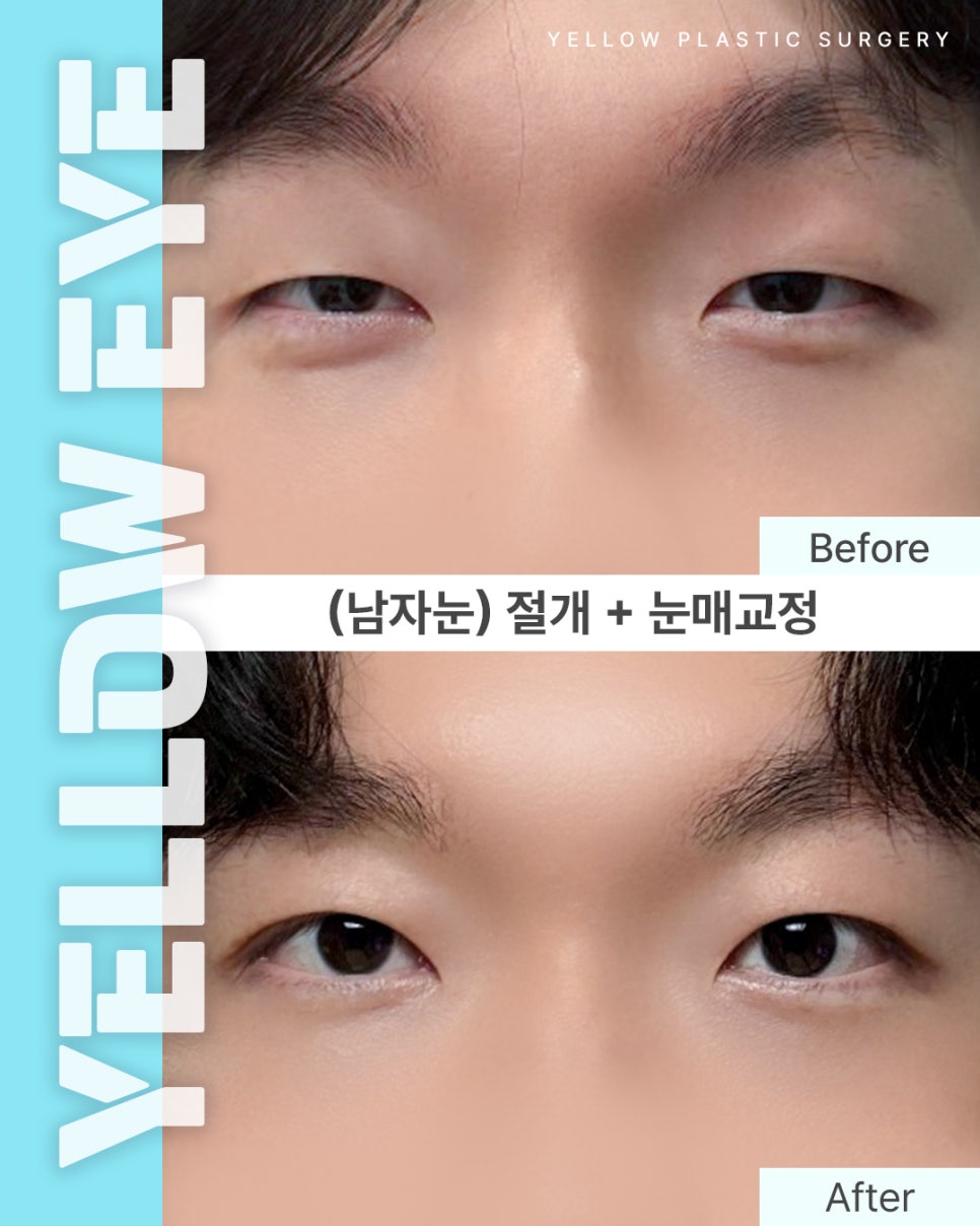[ Yellow Plastic Surgery Clinic at Gangnam Station / Eye Surgery ] (Male Eye Surgery) Incision + Eye Shape Correction image 1