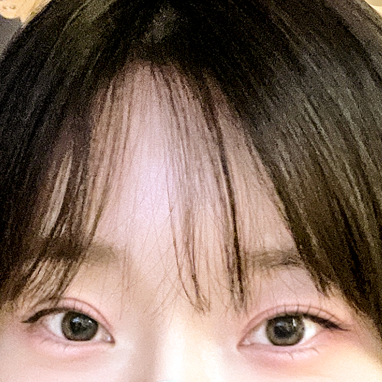 [Gangnam Station Yellow Plastic Surgery / Eye Surgery] Seven-Month Review After First Partial Incision Surgery: Improvement in Uneven Eyes image 10