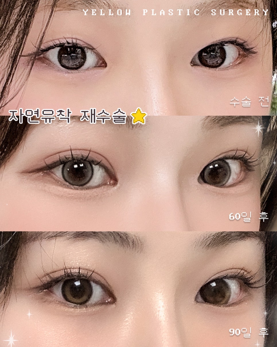[ 강남역 옐로우성형외과 / 눈성형 ] 자연유착 재수술 관련 이미지 1