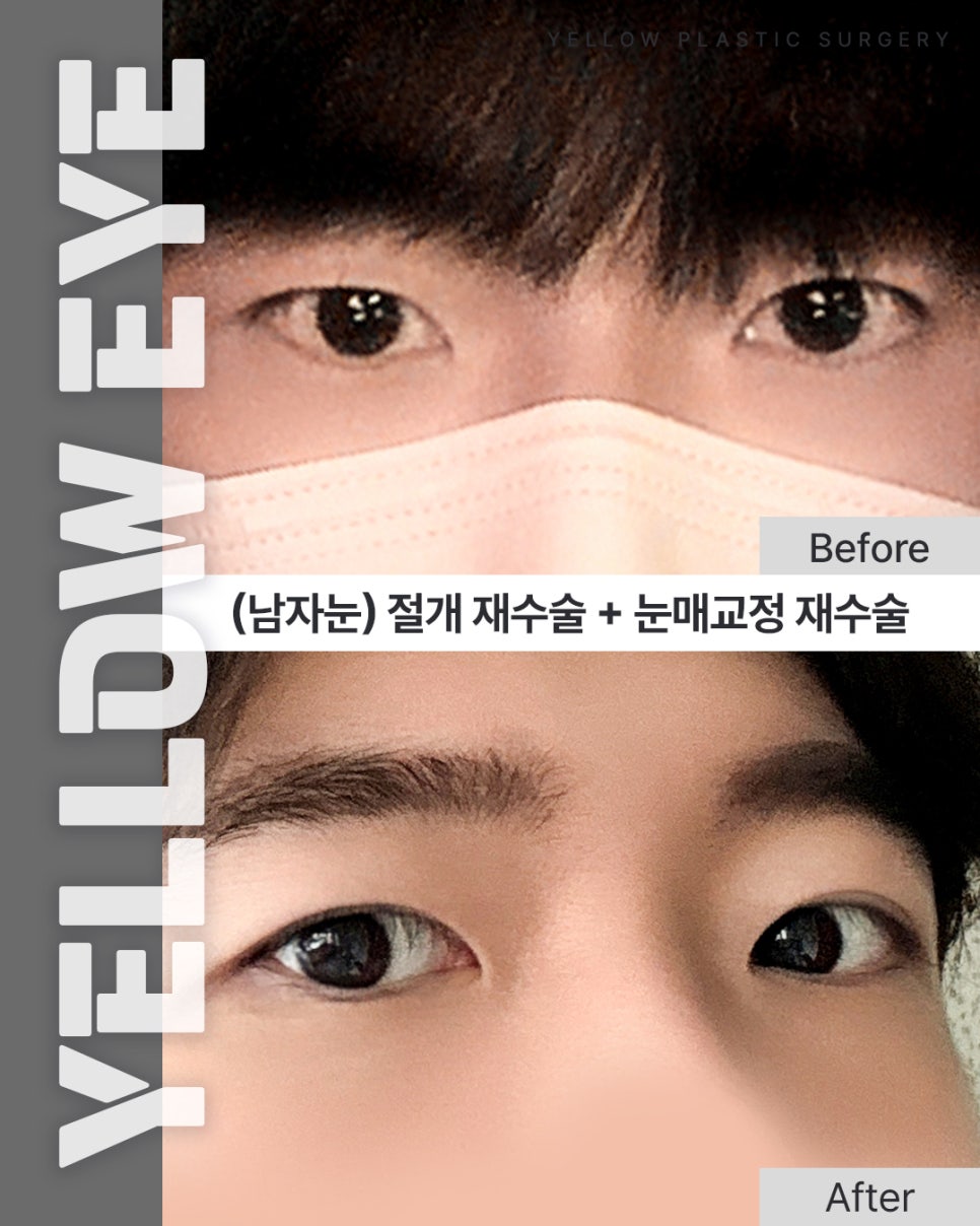 [ 강남역 옐로우성형외과 / 눈성형 ] (남자눈) 절개 재수술 + 눈매교정 재수술 관련 이미지 1