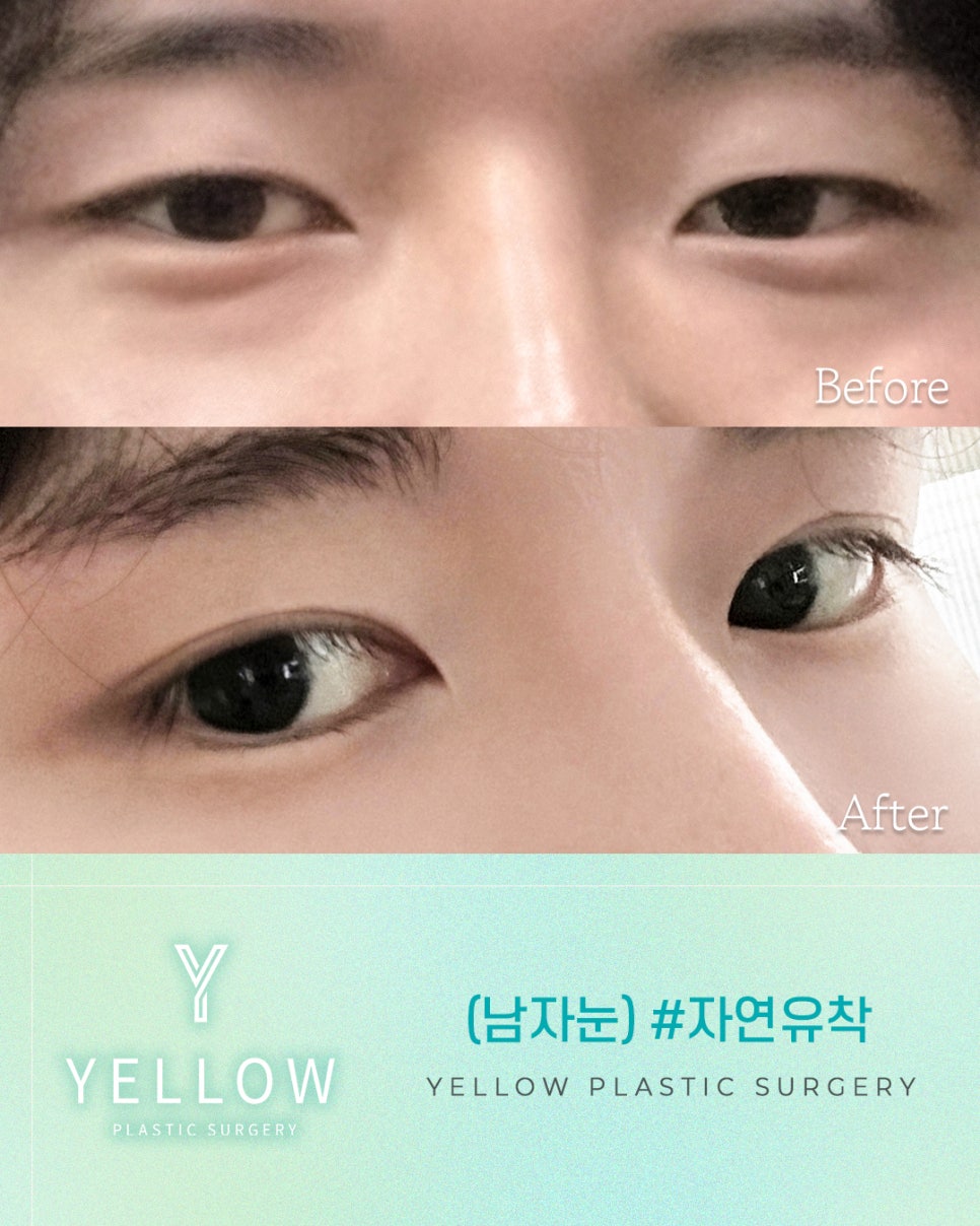 [ Gangnam Station Yellow Plastic Surgery / Eye Surgery ] (Men’s Eyes) Natural Adhesion image 1