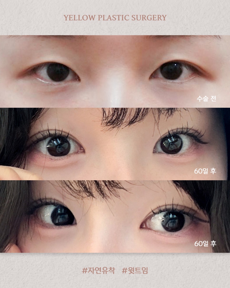 [ 강남역 옐로우성형외과 / 눈성형 ] 자연유착 + 윗트임 관련 이미지 1