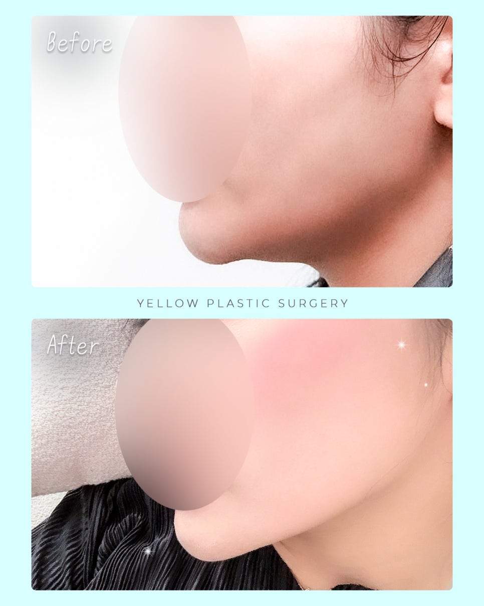 Gangnam Station Yellow Plastic Surgery / Ulthera Lifting image 1