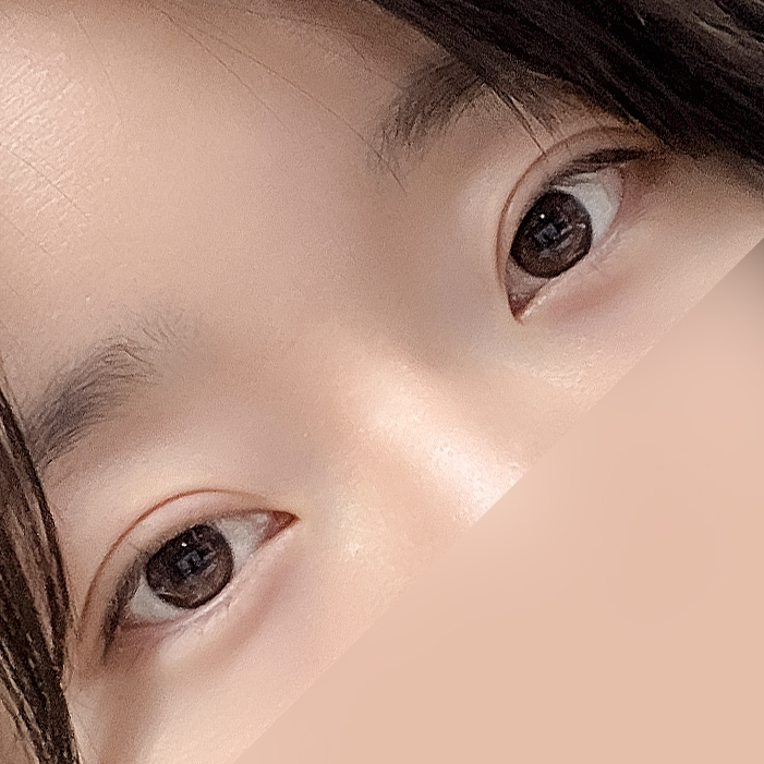 [Gangnam Station Yellow Plastic Surgery / Eye Surgery] Seven-Month Review After First Partial Incision Surgery: Improvement in Uneven Eyes image 15