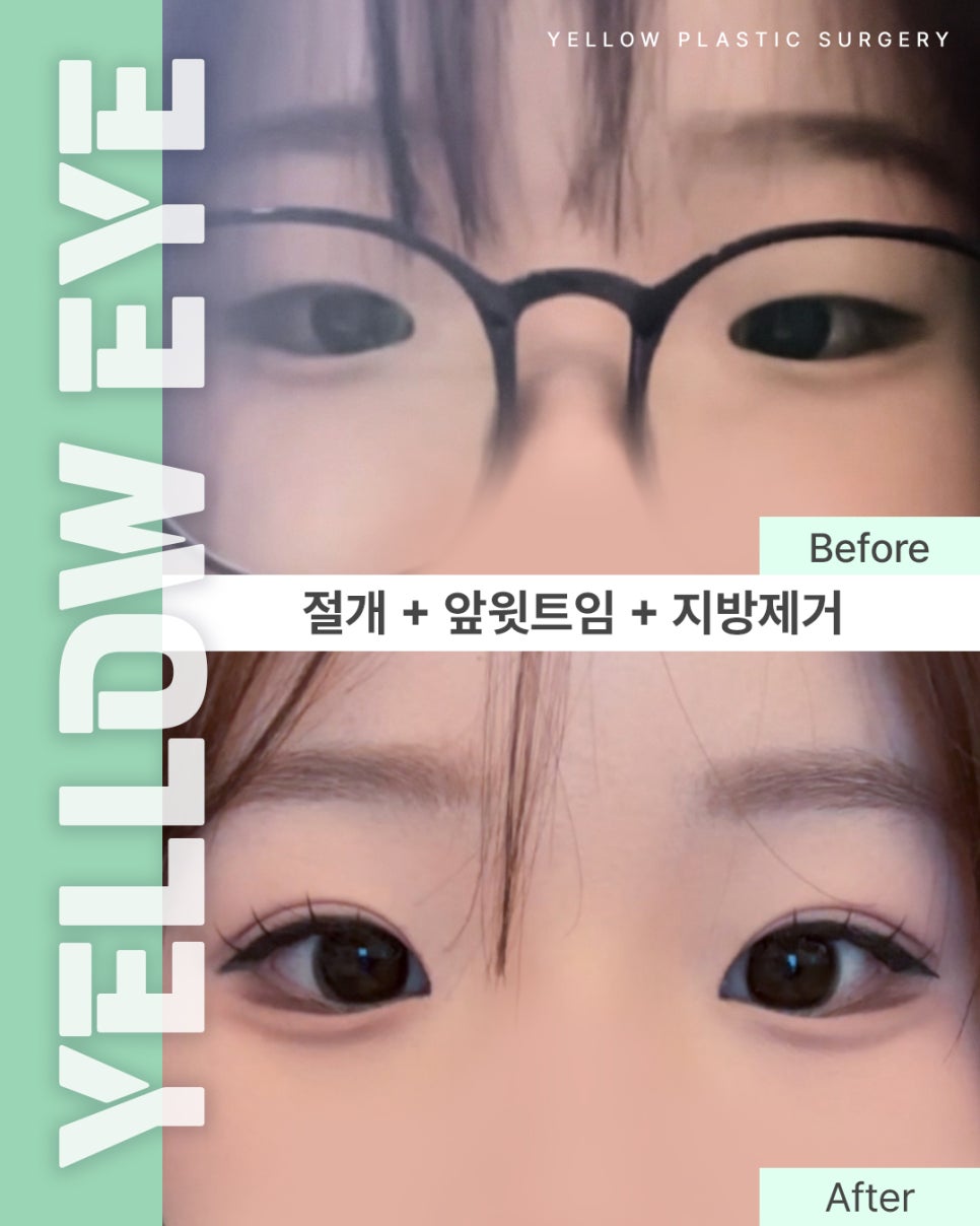 [ 강남역 옐로우성형외과 / 눈성형 ] 절개 + 앞윗트임 + 지방제거 관련 이미지 1