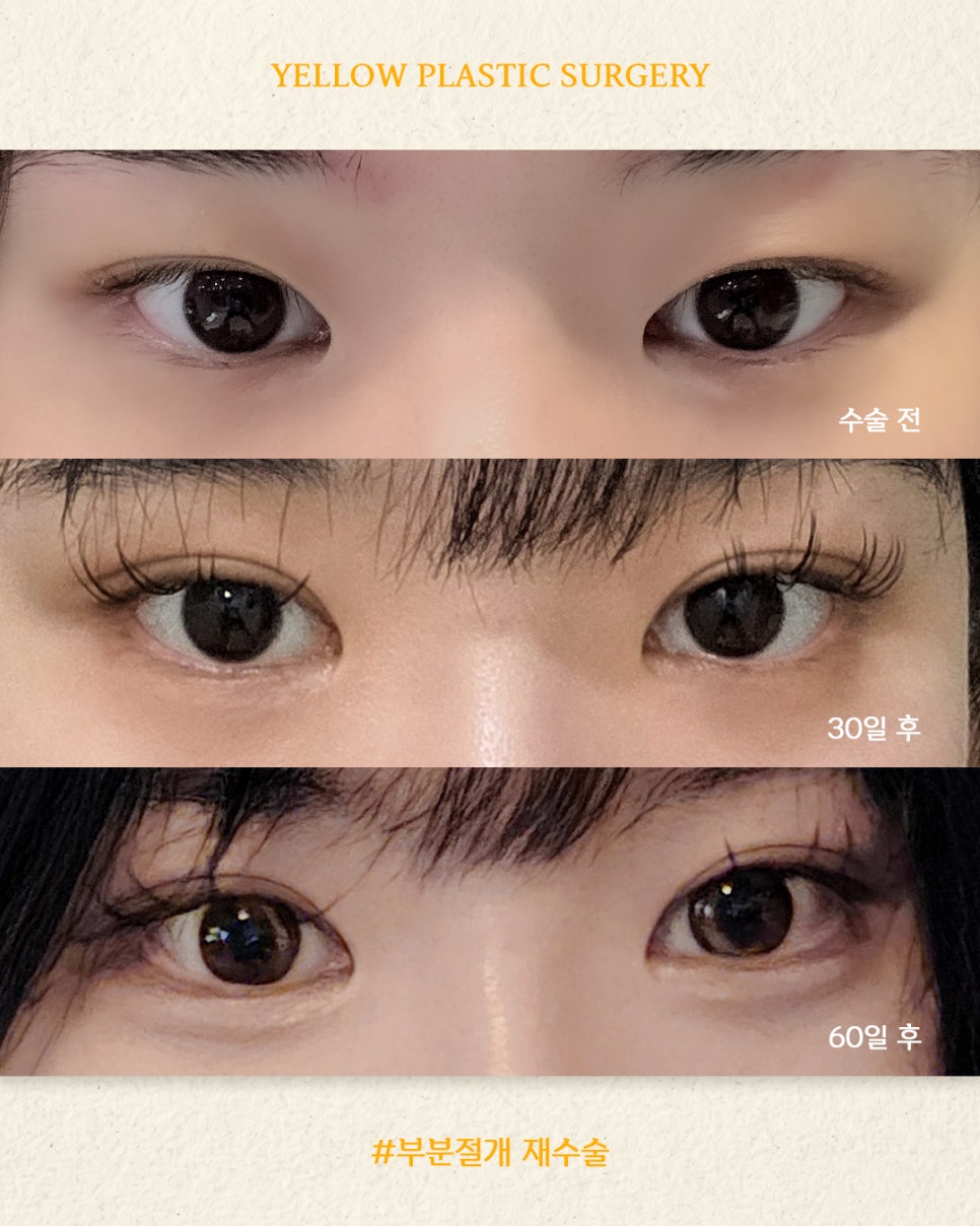 [ 강남역 옐로우성형외과 / 눈성형 ] 부분절개 재수술 관련 이미지 1