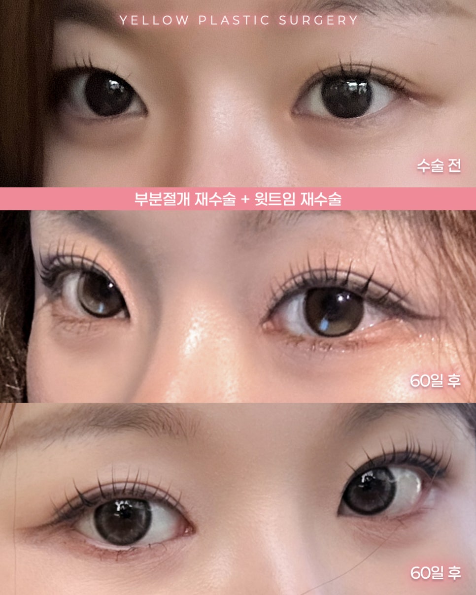 [ 강남역 옐로우성형외과 / 눈성형 ] 부분절개 재수술 + 윗트임 재수술 관련 이미지 1