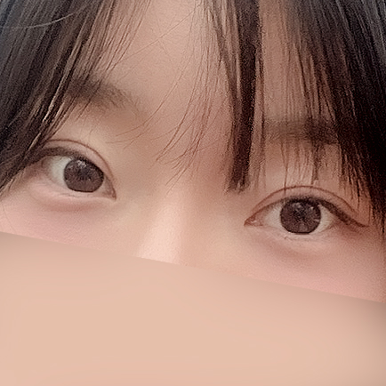 [Gangnam Station Yellow Plastic Surgery / Eye Surgery] Seven-Month Review After First Partial Incision Surgery: Improvement in Uneven Eyes image 14