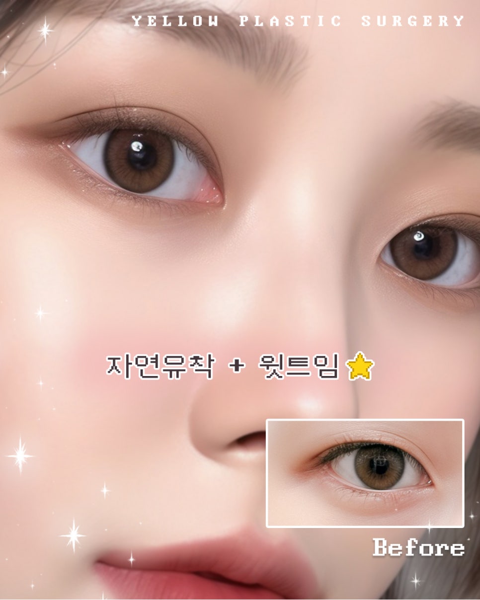 [ Gangnam Station Yellow Plastic Surgery / Eye Surgery ] Natural Adhesion + Upper Canthoplasty image 1