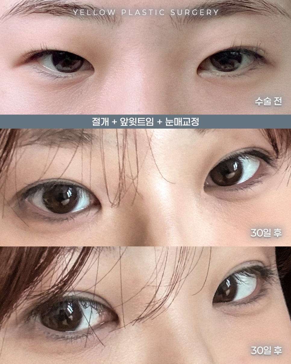[ 강남역 옐로우성형외과 / 눈성형 ] 절개 + 앞윗트임 + 눈매교정 관련 이미지 1