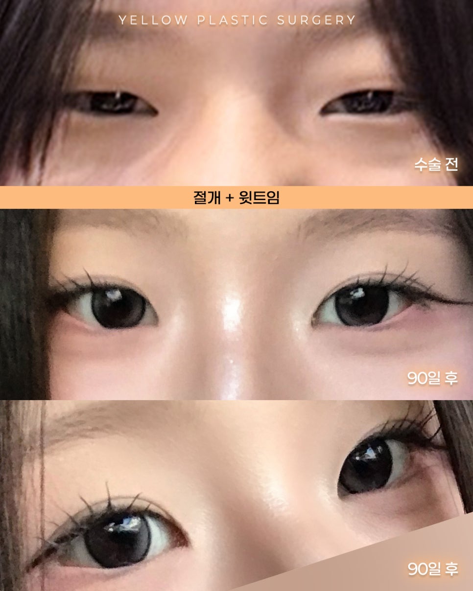 [ 강남역 옐로우성형외과 / 눈성형 ] 절개 + 윗트임 관련 이미지 1