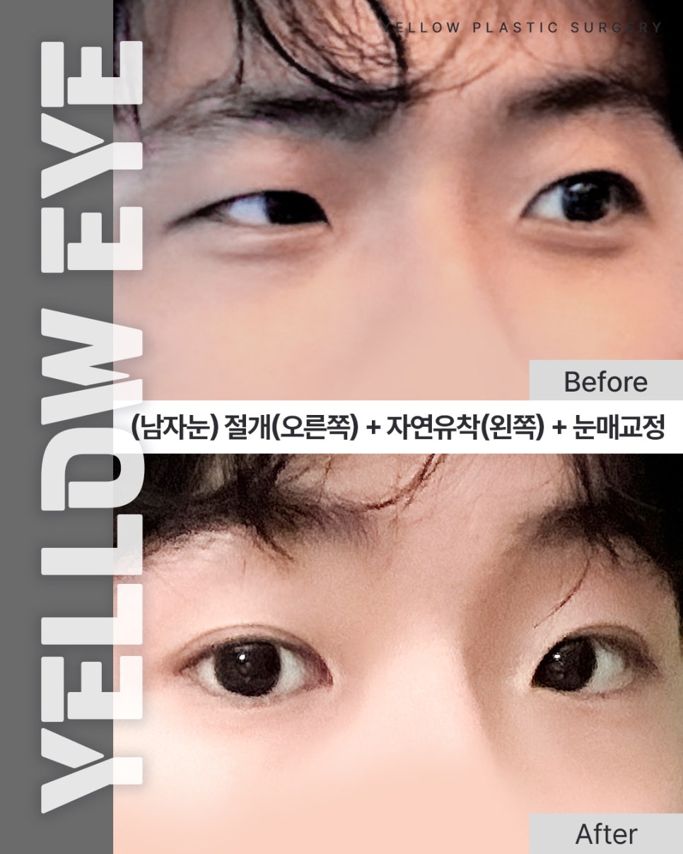 [ 강남역 옐로우성형외과 / 눈성형 ] (남자눈) 절개(오른쪽) + 자연유착(왼쪽) + 눈매교정 관련 이미지 1