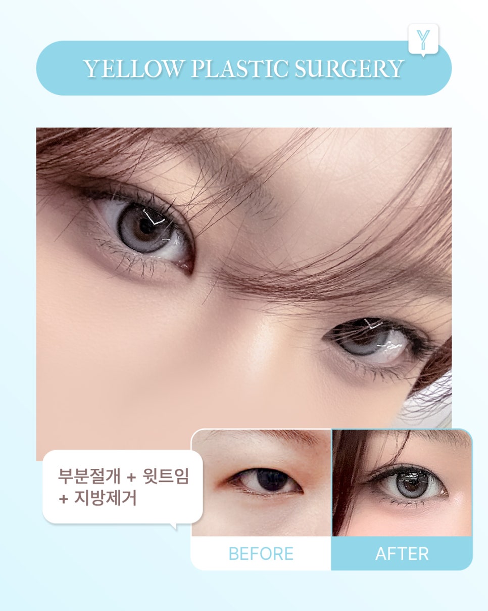 [ 강남역 옐로우성형외과 / 눈성형 ] 부분절개 + 윗트임 + 지방제거 관련 이미지 1