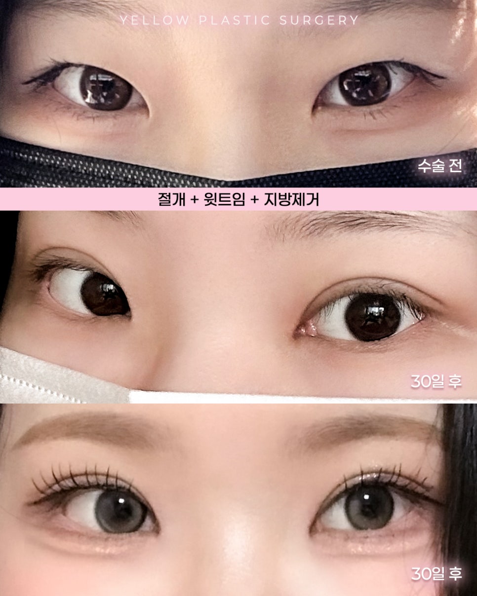 [ 강남역 옐로우성형외과 / 눈성형 ] 절개 + 윗트임 + 지방제거 관련 이미지 1