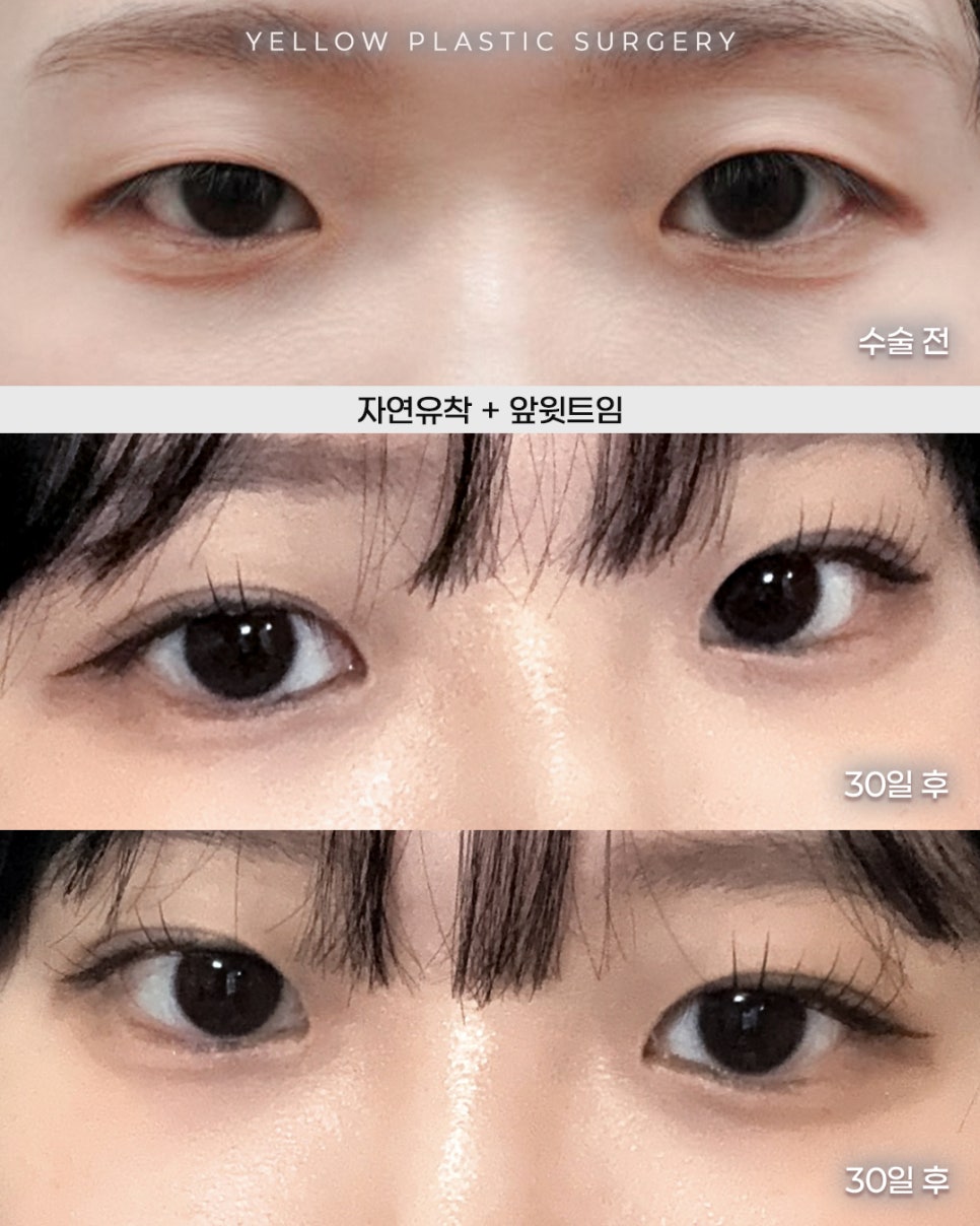 [ 강남역 옐로우성형외과 / 눈성형 ] 자연유착 + 앞윗트임 관련 이미지 1