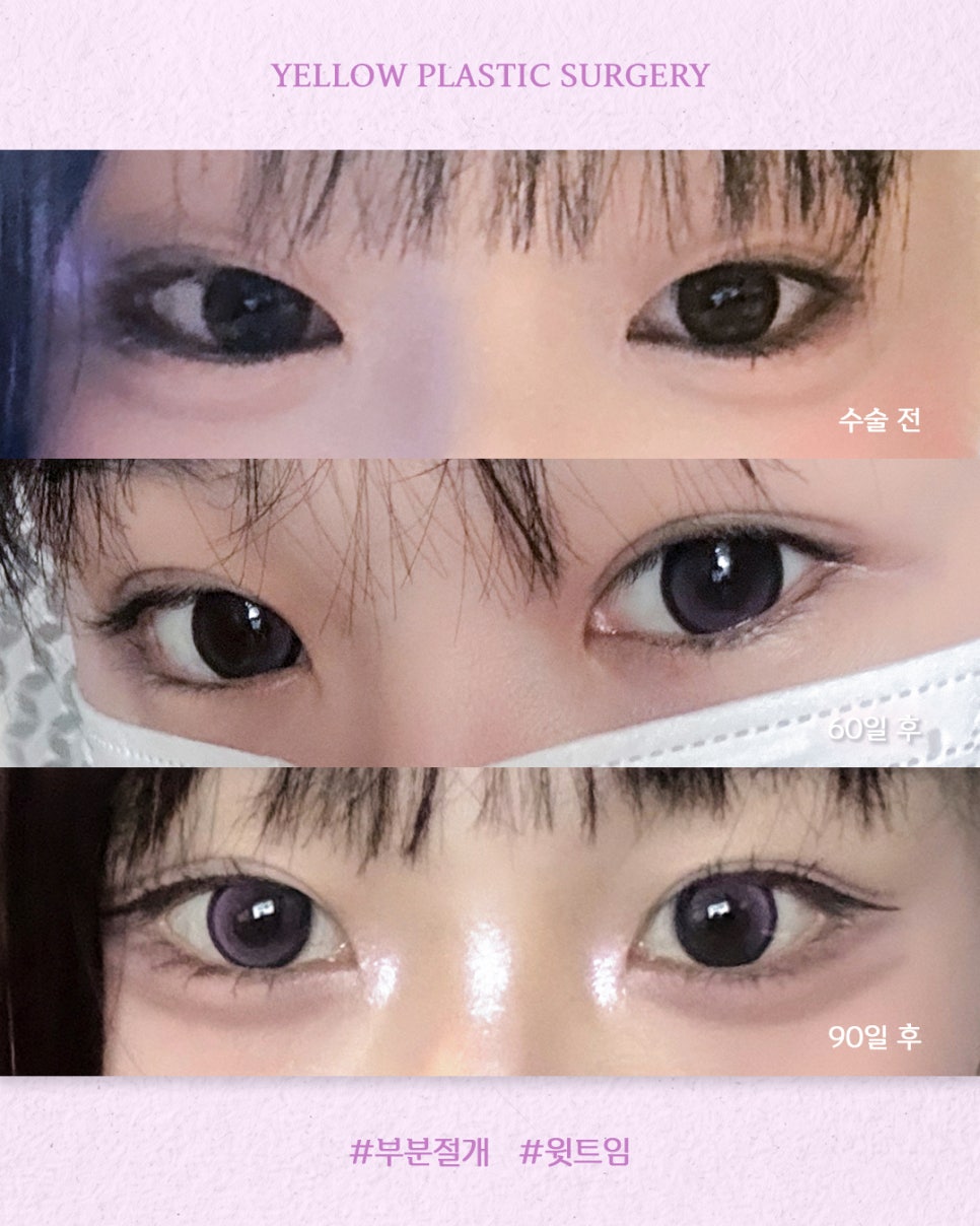 [ 강남역 옐로우성형외과 / 눈성형 ] 부분절개 + 윗트임 관련 이미지 1