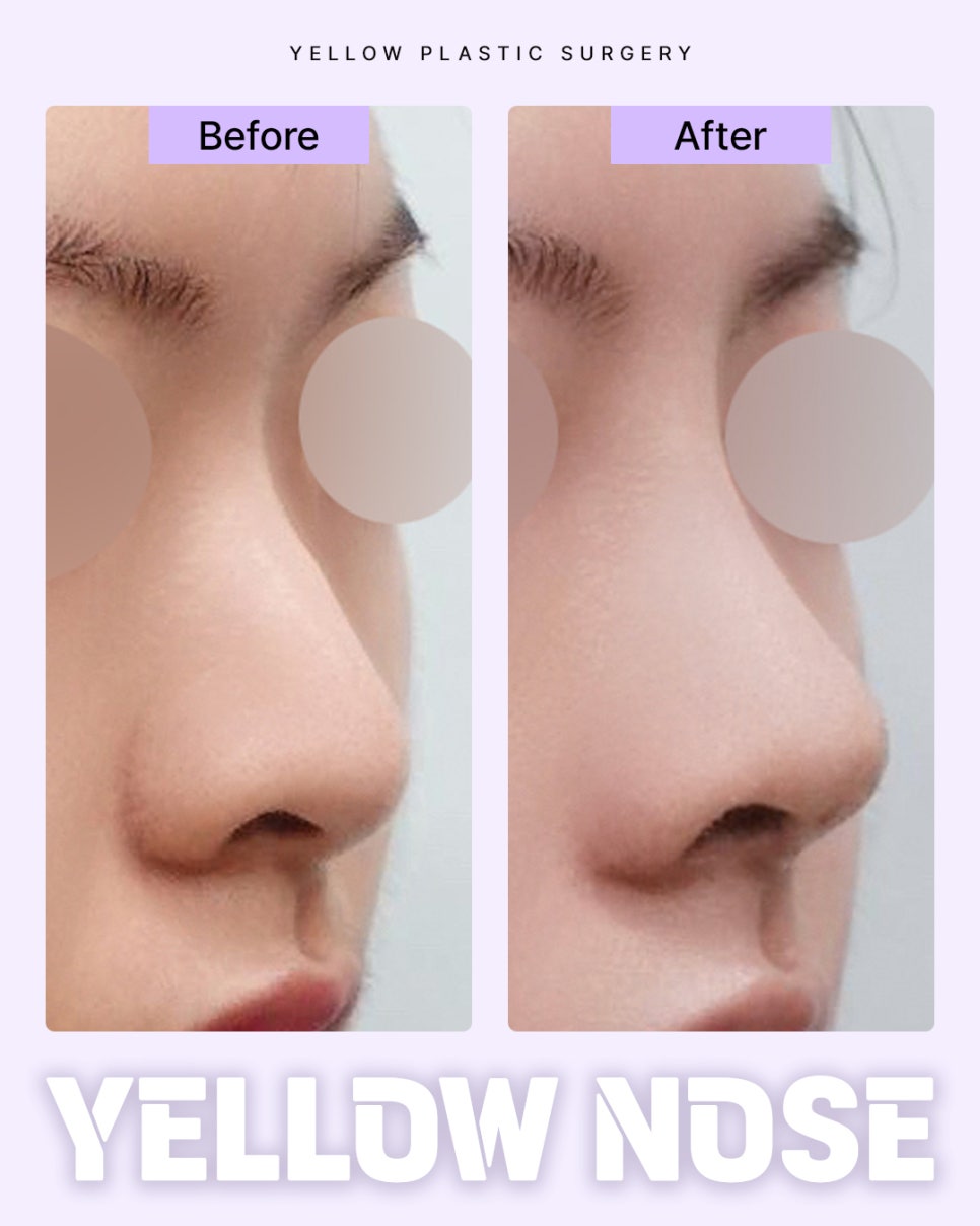 Gangnam Station Yellow Plastic Surgery / Rhinoplasty image 1