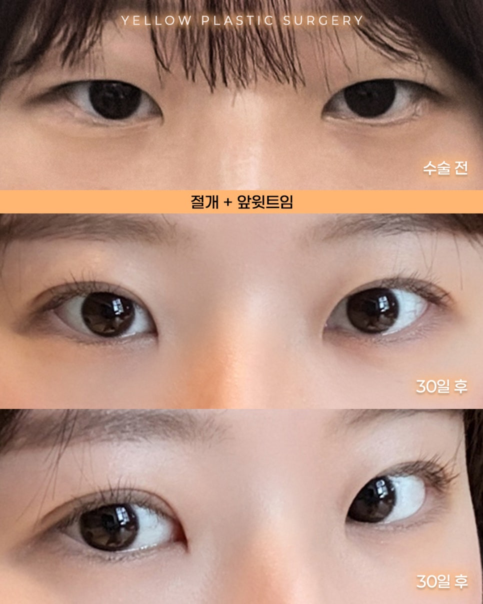 [ 강남역 옐로우성형외과 / 눈성형 ] 절개 + 앞윗트임 관련 이미지 1