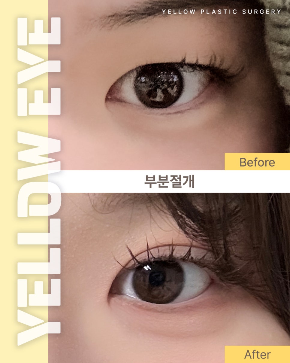 [ 강남역 옐로우성형외과 / 눈성형 ] 부분절개 관련 이미지 1