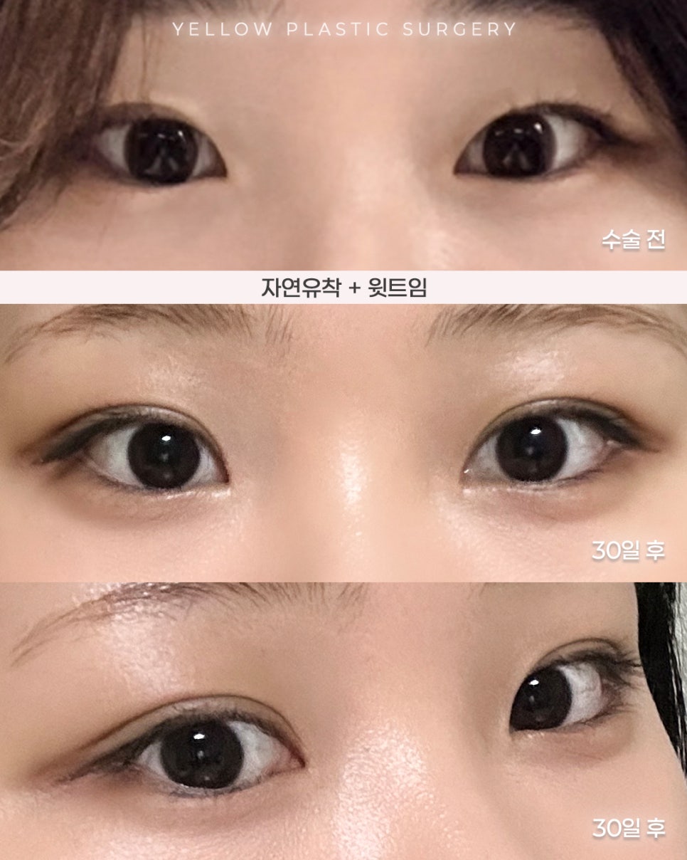 [ Gangnam Station Yellow Plastic Surgery / Eye Surgery ] Natural Adhesion + Upper Canthoplasty image 1