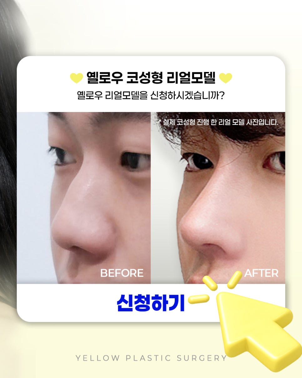 옐로우 코성형 리얼모델 모집 관련 이미지 3