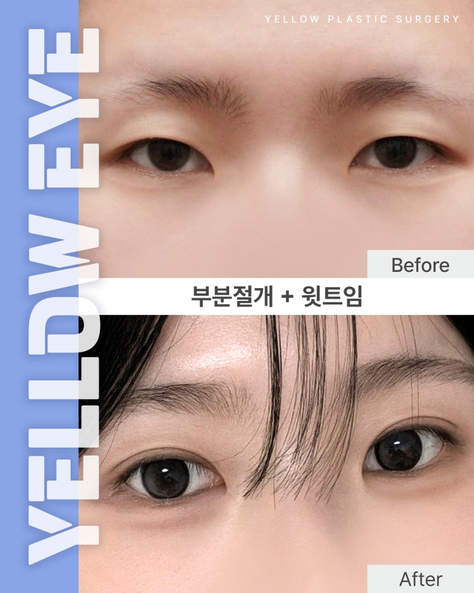 [ 강남역 옐로우성형외과 / 눈성형 ] 부분절개 + 윗트임 관련 이미지 1