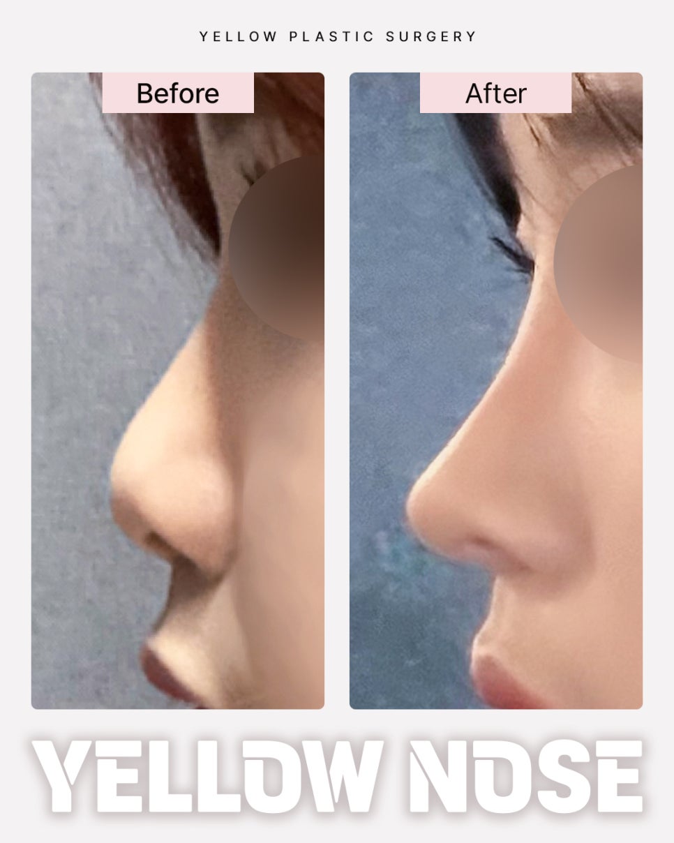 [ Yellow Plastic Surgery at Gangnam Station / Rhinoplasty ] image 1