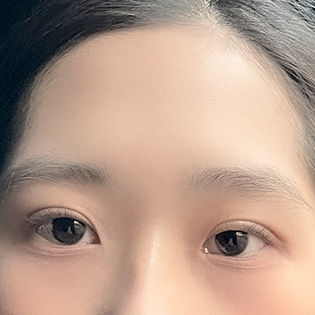 [ 강남역 옐로우성형외과 / 눈성형 ]  자연유착 눈수술 쌍수 후기 관련 이미지 5