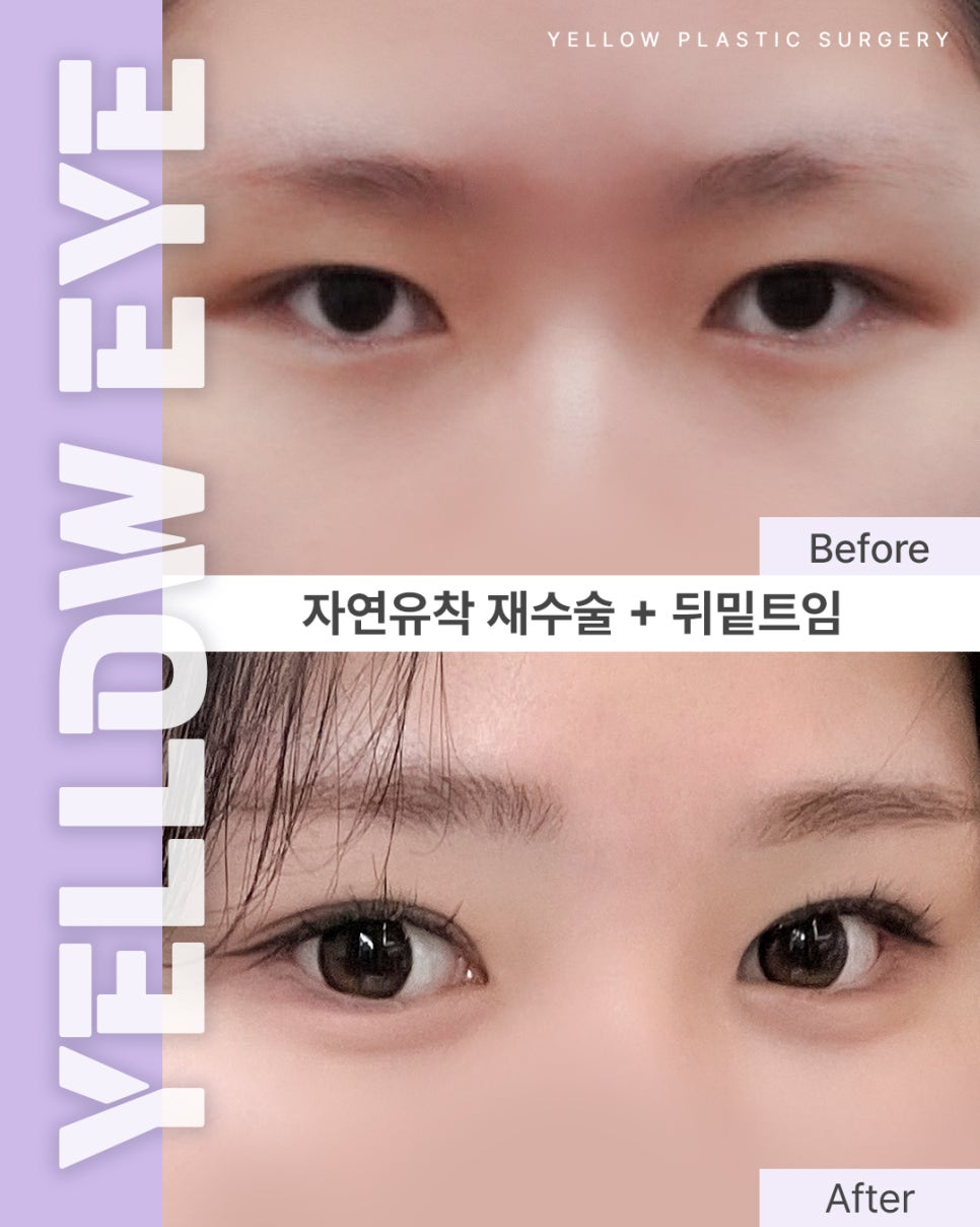 [Gangnam Station Yellow Plastic Surgery / Eye Plastic Surgery] Reoperation After Natural Adhesion + Canthoplasty and Lower Canthoplasty image 1