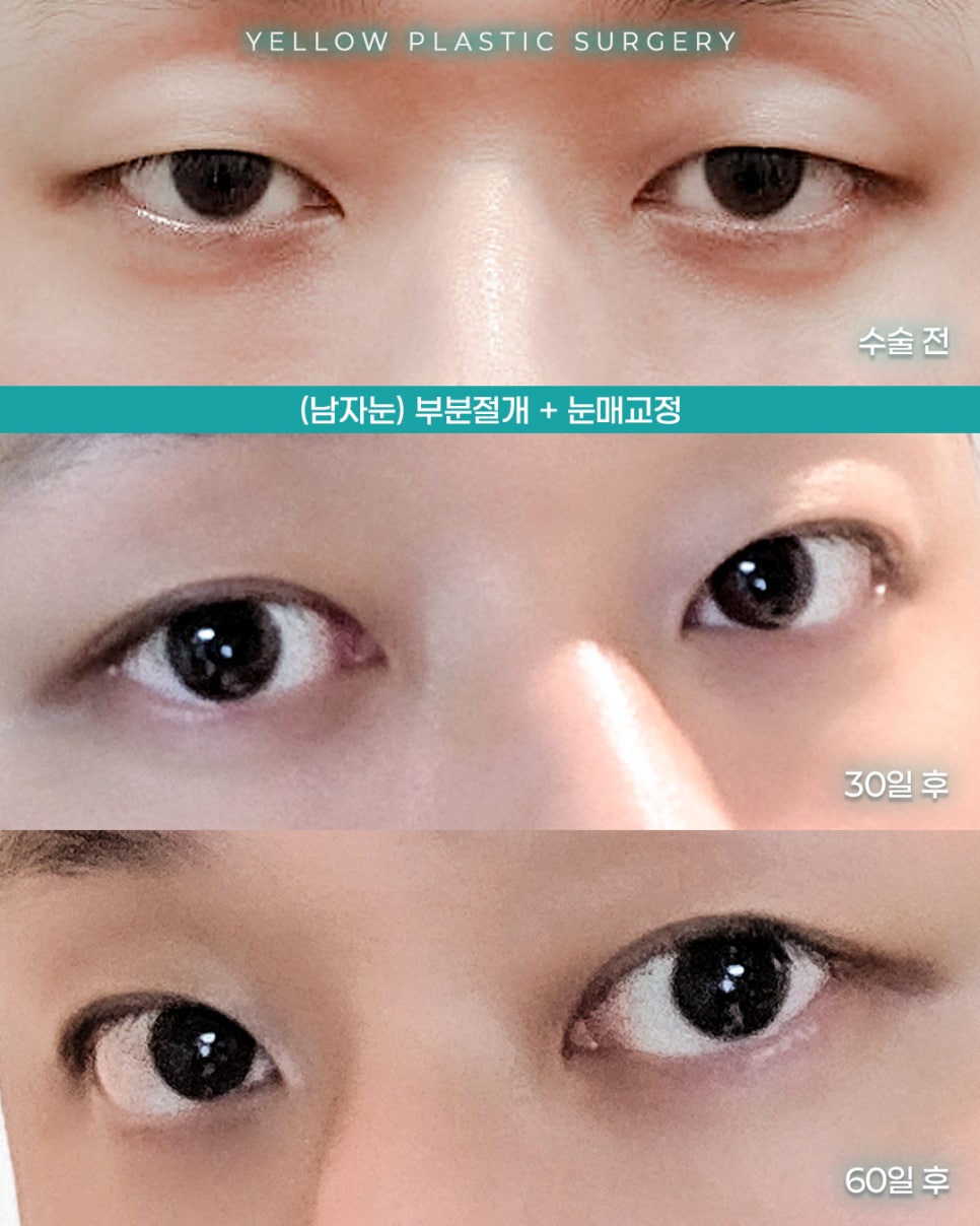 [ Gangnam Station Yellow Plastic Surgery / Eye Surgery ] (Men’s Eyes) Partial Incision + Ptosis Correction image 1