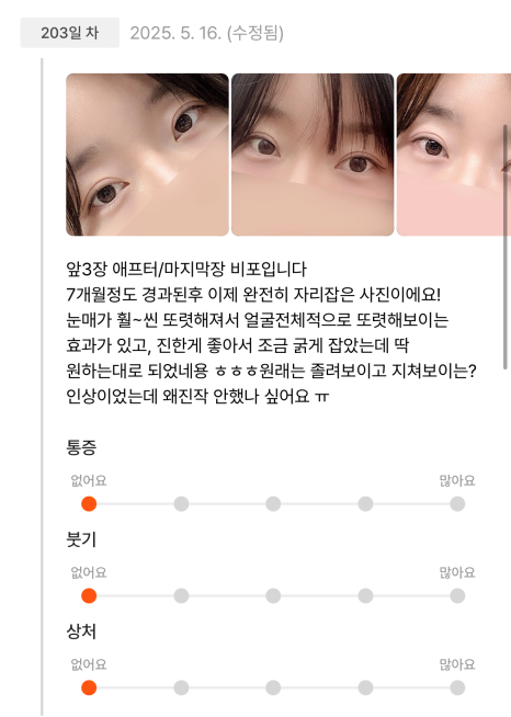 [Gangnam Station Yellow Plastic Surgery / Eye Surgery] Seven-Month Review After First Partial Incision Surgery: Improvement in Uneven Eyes image 4