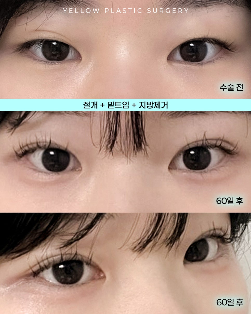 [ 강남역 옐로우성형외과 / 눈성형 ] 절개 + 밑트임 + 지방제거 관련 이미지 1