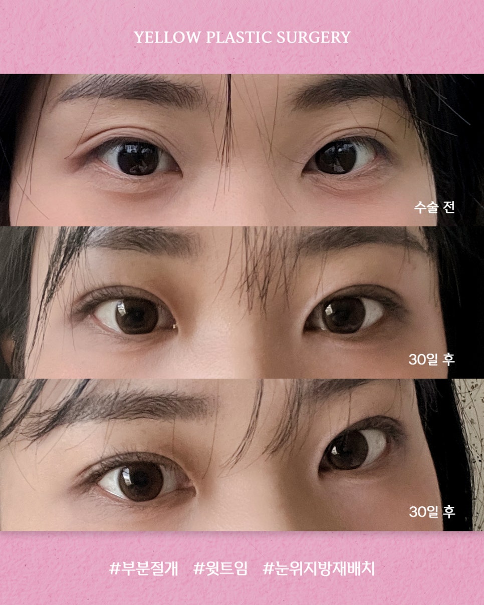 [ 강남역 옐로우성형외과 / 눈성형 ] 부분절개 + 윗트임 + 눈위지방재배치 관련 이미지 1