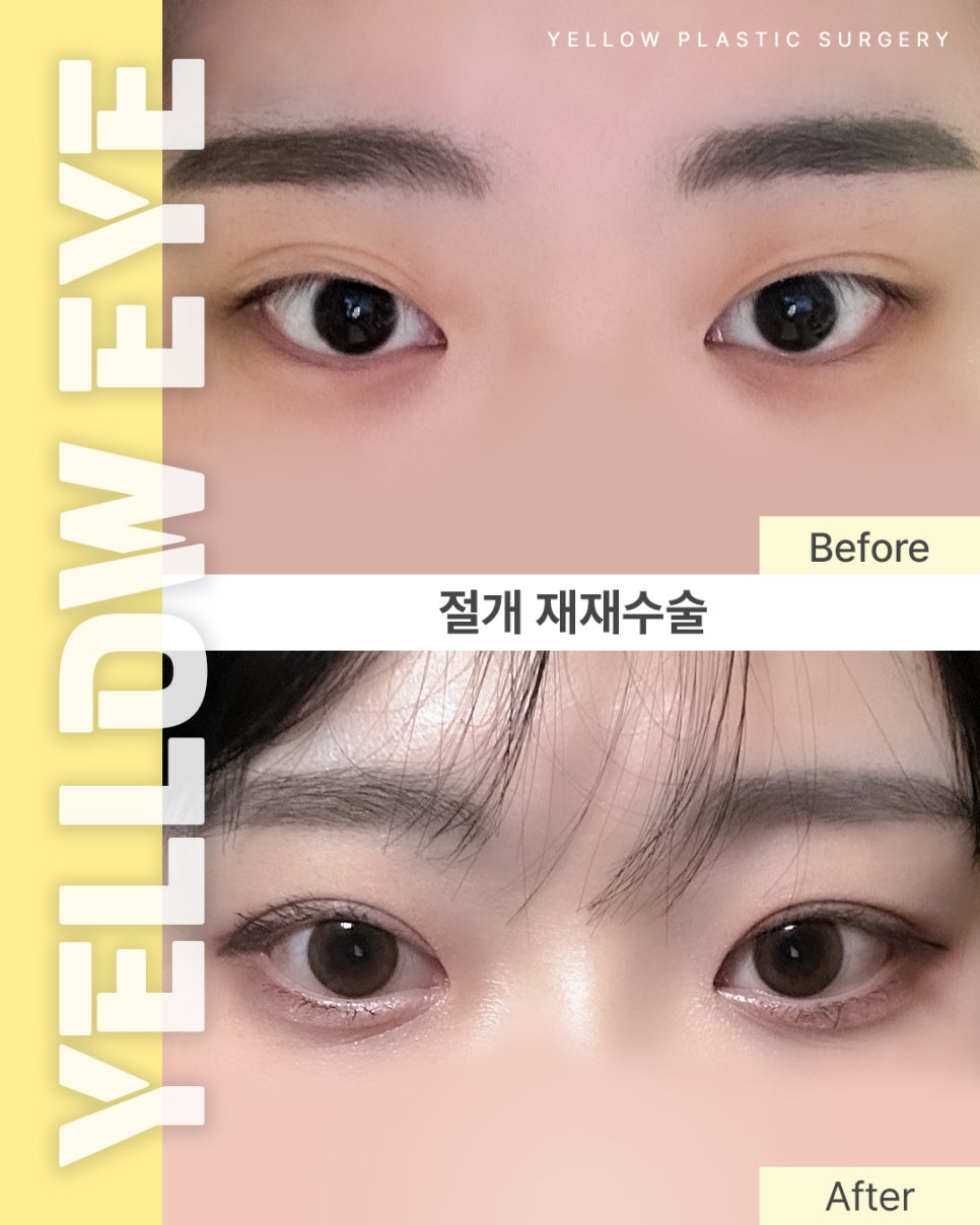 [Gangnam Station Yellow Plastic Surgery / Eye Surgery] Incisional Re-revision Surgery image 1
