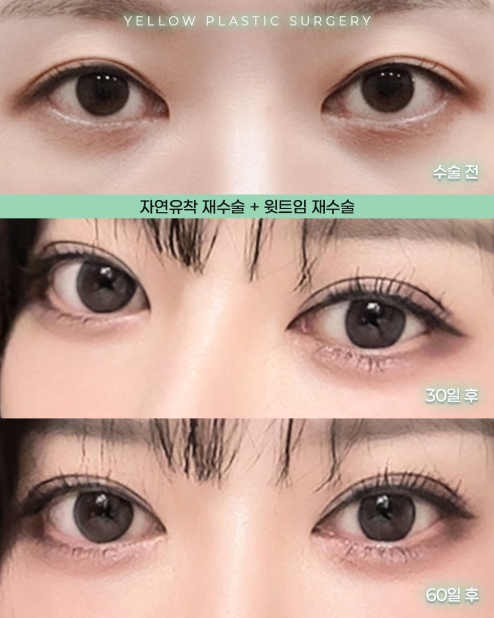 [Gangnam Station Yellow Plastic Surgery / Eye Surgery] Natural Adhesion Revision Surgery + Upper Eyelid Incision Revision Surgery image 1